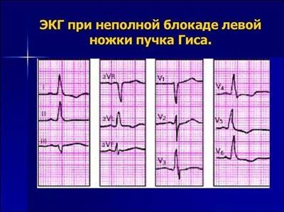 Признаки на ЭКГ