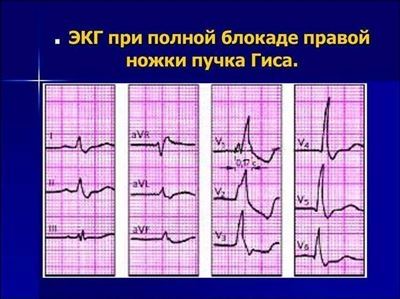 Возможные причины развития блокады правой ножки пучка Гиса