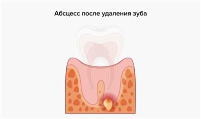 Получение больничного при флюсе