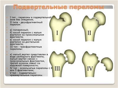 Реабилитация после перелома бедра