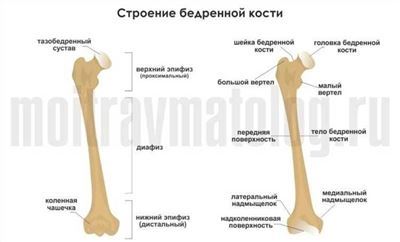 Перелом бедра смещенный