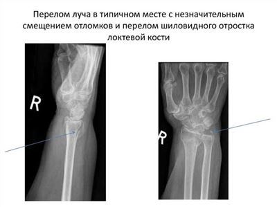 Особенности строения костей предплечья