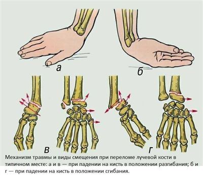 Причины переломов и группы риска