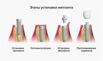 Особенности оформления налогового вычета на стоматологические услуги